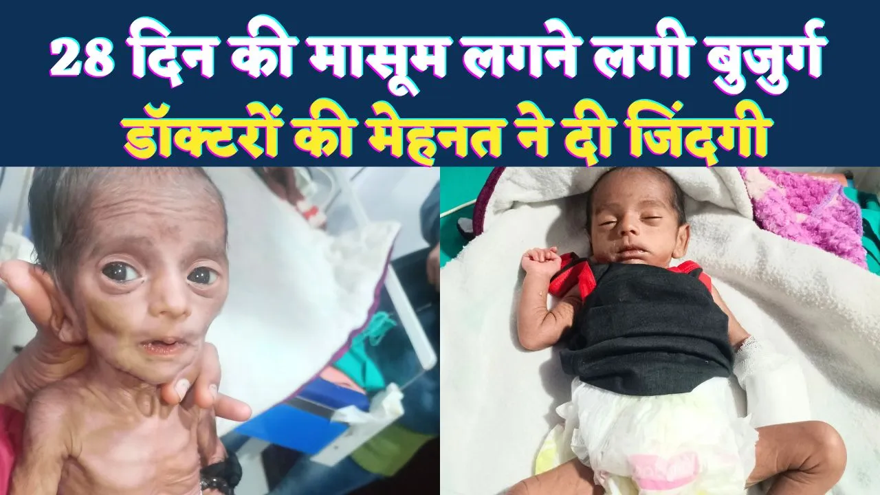 Fatehpur News: 28 दिन की मासूम अचानक दिखने लगी बुजुर्ग, डॉक्टरों की कड़ी मेहनत ने महज 5 दिन में दी नई जिंदगी