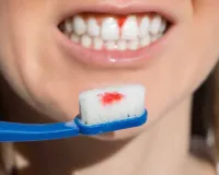 Bleeding Gums: ब्रश करने के दौरान निकलता है मुँह से खून ! तुरंत ही डेंटिस्ट को जाकर दिखाएं