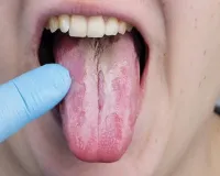 Tongue Colour: जीभ के बदलते हुए रंग से डॉक्टर्स ऐसे लगाते है बड़ी से बड़ी बीमारियों का पता ! आप भी करें चेक