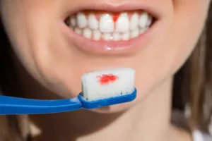 Bleeding Gums: ब्रश करने के दौरान निकलता है मुँह से खून ! तुरंत ही डेंटिस्ट को जाकर दिखाएं