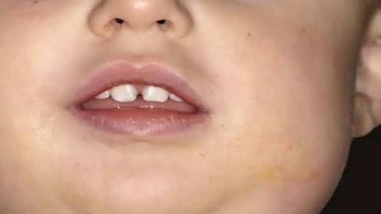 mumps_disease_harmful_health